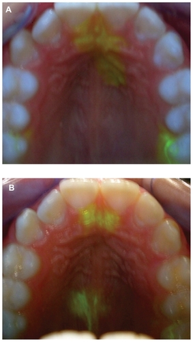 Figure 1 (A) Lingual apex positioned at upper incisors and (B) lingual apex repositioned to the rear incisive papilla.