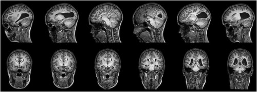 Figure 1. Magnetic resonance imaging reveals a complete, isolated agenesis of the corpus callosum with colpocephaly; neurological convention.