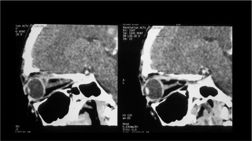 Figure 10 Postoperative CT image.