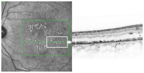 Figure 5 Example of the retinal optical coherence topography morphology of laser spots.