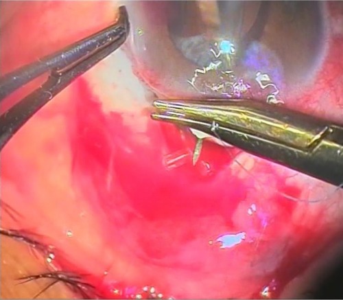 Figure 8 Closure of the scleral flap over the ring.