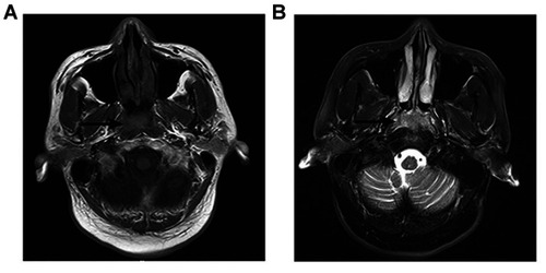 Figure 3 MRI showed that the soft tissue mass occupied the top of the nasopharynx (black arrow). TIWI showed a moderate signal (A) and T2W1 showed a slightly high signal (B).