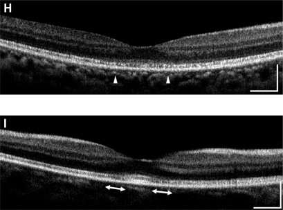 Figure 2 Fourier-domain optical coherence tomography (FD-OCT) images (horizontal scan) of normal eye (A), and right/left eyes of patient 1 (B, C), patient 2 (D, E), patient 3 (F, G), and patient 4 (H, I). Horizontal bars represent 500 μm, and vertical bars represent 200 μm. The eyes in patients 1–4 had a bilateral symmetric decline in visual acuity, whereas those in patient 5 had an assymmetric decline (20/200 right eye, 20/20 left eye). FD-OCT in normal eye provided clear images of the retinal layers. The external limiting membrane (ELM), photoreceptors inner and outer segment (IS/OS) junction, third line, and retinal pigment epithelium (RPE) are distinguishable. Meanwhile, the retinal photoreceptor layer is not clear in the eyes of the patients. Although ELM was visualized in all eyes, IS/OS is elevated and disrupted in fovea (B, C, D, E, H), widely disrupted and not clear (F, G), and clearly visualized in one eye (I). The third line was visualized only in one eye (I), just in the fovea.