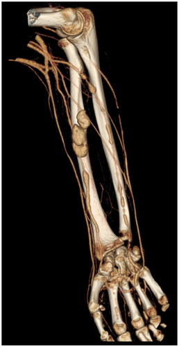 Figure 2. CT Angiogram showed multiple pseudoaneurysms along radial and ulnar arteries.