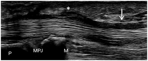 Figure 1. The ultrasounds examination shows an irregular region (arrow) of the flexor digitorum superficialis tendon suggestive of a partial rupture, accompanied by the thickening of the pulley A1 (asterisk). P: Proximal Phalanx; M: Metacarpus; MPJ: Metacarpo-Phalangeal Joint.