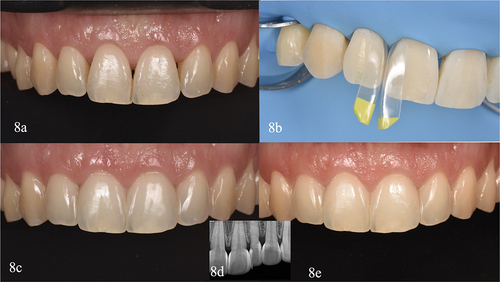 Figure 8. Case VI. (a) Initial intraoral front view. (b) Detail of the isolated teeth, example of two large yellow specific matrices for black triangles were selected (black triangle kit. Bioclear matrix systems. Bioclear) to closure the black triangle between mesial right upper lateral and distal right upper central incisor. (c) Two weeks clinical review. (d) Two weeks radiographic control composition to check the perfect adaptation of composite and the absence of retentive areas. (e) Two years review, highlighting the amazing periodontal condition and the integrity of the restorations.