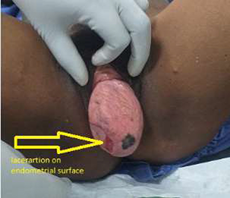 Figure 2 Laceration on endometrial surface, photo taken on supine position on 10th post-operative day after abdominal hysterectomy was done. Vaginal epithelium looks healthy.