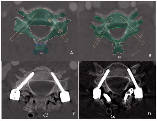 Figure 2. The planned screw trajectories of among C1 (A), left C2 (B), and right C2 (C). Postoperative CT demonstrated that the trajectory deviations were 3.1 mm at the left C1, which broke the inside wall of lateral mass (grade 1), 0.3 mm at the right C1 (D), 0.2 mm at the left C2 (E), and 0.5 mm at the right C2 (F).