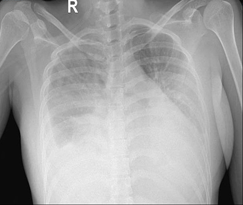 Figure 2 Admission chest radiograph demonstrating interstitial lesions, parenchymal consolidation of the lower two thirds of the lungs, and moderate right pleural effusion.