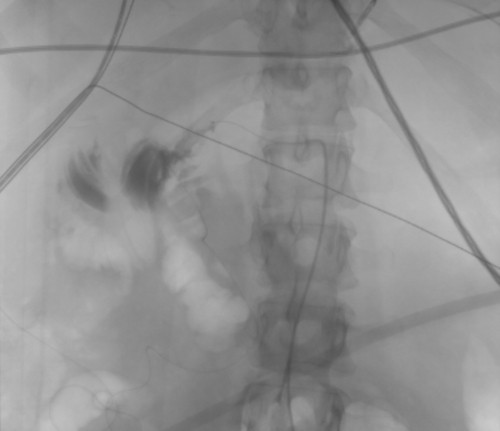 Figure 2. Angiogram showing contrast extravasation from the hepatic artery