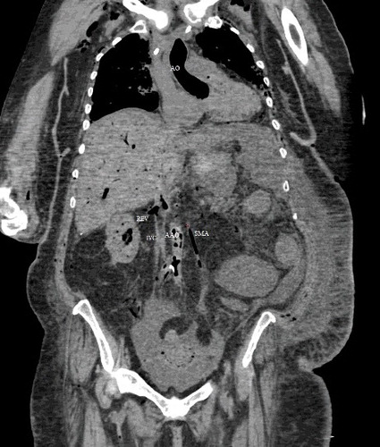 Figure 6. Coronal view (soft tissue window): intravascular air noted in the ascending aorta (AO), right renal vein (REV), inferior vena cava (IVC), abdominal aorta (AAO) and superior mesenteric artery (SMA).