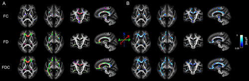 Figure 1 Whole-brain FBA results. Fiber tract-specific differences among AD-nLGS, AD-LGS and NC are shown. Streamline segments were cropped from the template tractogram to include only those corresponding to fixels significant at family-wise error-corrected P<0.05. Streamlines were colored by (A) fiber direction (A-P indicates anterior-posterior, green; L-R, left-right, red; and S-I, superior inferior, blue.) and (B) family-wise error-corrected P value for fiber density (FD), fiber cross-section (FC), and combined fiber density and cross-section (FDC).
