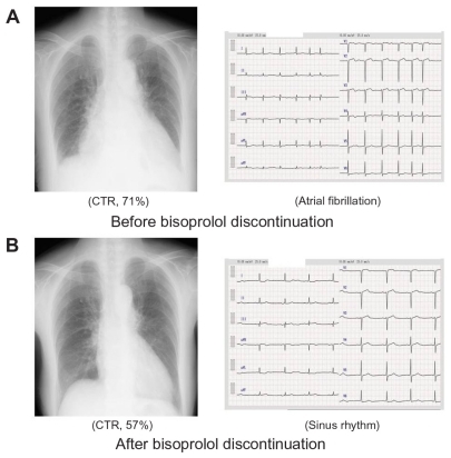 Figure 1 At the time of the most severe condition, the chest radiograph showed cardiomegaly with cardiothoracic ratio (CTR) of 71%; an electrocardiogram revealed atrial fibrillation with a QS pattern in the V1–V3 leads A). After bisoprolol discontinuation, the CTR determined by chest radiography was reduced to 57%, and atrial fibrillation converted to sinus rhythm B).