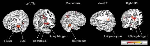 Figure 3. Functional connectivity of seed regions (in larger font, corrected for multiple comparisons) with other brain areas (smaller font) for the main effect of number of abuse on the CA group. TPJ = temporo-parietal junction; dmPFC = dorsomedial prefrontal cortex; STG = superior temporal gyrus; R, right; L, left.