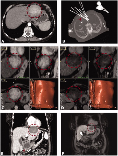 Figure 2. Case of a 54-year old female with a 6-cm subcardiac HCC in segment II. (A) Arterial phase initial CT with a hypervascular hepatocellular carcinoma (HCC) in segment II (red dashed circle). (B) Maximum intensity projection (MIP) image of the control CT with 6 coaxial needles in place (red arrowhead). (C and D) Screenshots of the Treon navigation system – (C) showing fused images of the arterial phase planning CT with the arterial phase control CT (D). The red dashed circle delineates the HCC before and after ablation. (D) shows a completely overlapping ablation zone with no evidence of residual tumor and a sufficient safety margin. Follow up CT and after 3 (E) and MRI after 24 months (F) showing no evidence of local tumor recurrence. (E and F) with the red dashed circle delineating ablation zones. Note a pancreatic pseudocyst (red arrowhead) as an incidental finding.