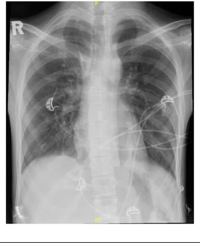 Figure 1 Chest X-ray showing right lung lower lobe consolidation.