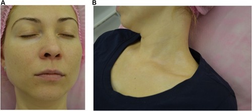 Figure 4 Patient L, areas of vitiligo on the face (A) and the neck (B) before the treatment with NCTF135.