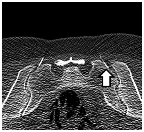 Figure 2 Bilateral CT-guided SI joint injection in low-dose protocol.