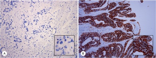 Figure 1 IHC staining of HER2 in gastric cancer samples.Notes: The typical images of HER2 status in gastric cancer samples are presented, magnification 20×, including; HER2 negative (IHC 0, A) and HER2 positive, (IHC 3+, B). Magnification 20× (large), 40× (small).Abbreviations: HER2, human epidermal growth factor receptor 2; IHC, immunohistochemistry.