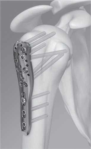 Figure 3. Locking plate for proximal humeral fractures (Philos). Reprinted with permission from Synthes.