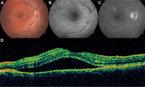 Figure 40 Central serous chorioretinopathy.