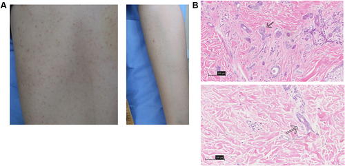 Figure 1 The clinical and pathological pictures of the patients. (A) Widely distributed flesh-coloured papules on the forebreast and left upper extremity region. (B) Micrographs showed that the dermis was filled with multiple vessels embedded in the dense collagen stroma; the inner layer of the duct is lined with flattened epithelial cells with a comma-like appearance (H&E; Bar length =100 μm; arrows indicate the comma-like appearance of eruptive syringoma).