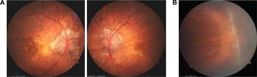 Figure 1 Myopic fundi showing (A) peridiscal crescent, posterior staphyloma and (B) peripheral retinal lattice degeneration.