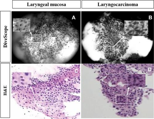 Figure 3 DiveScope images and hematoxylin-eosin (HE) staining pathology images of cells from healthy tissues and malignant tissues in the head and neck. Figures (A and C) are a DiveScope image and an HE staining pathology image of healthy mucosal epithelial tissues in the larynx, respectively. Figures (B and D) are a DiveScope image and an HE staining pathology image of laryngeal squamous cell carcinoma tissues. Figure (A) (Magnification: 500X): Healthy mucosal epithelium in the larynx. Cells and the cell nucleus morphology were regular and neatly arranged, the cell nucleus and cytoplasm were evenly stained, and the nucleolar structure could be observed in some cells (the white box shown in Figure (A). These characteristics are similar to those shown in Figure (C) (the white box shown in Figure (C). Figure (B) (Magnification: 500X): Squamous cell carcinoma tissues in the larynx. The cell nuclei were enlarged, deeply stained, irregular in morphology, and not neatly arranged (some nuclei were arranged together), showing typical pathological characteristics of squamous cell carcinoma (white box in figure (B). These characteristics are similar to those shown in Figure (D) (the white box shown in Figure (D).