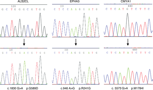 Figure 1 Presumed somatic mutations in ALS2CL, EPHA3 and CMYA1. Direct genomic sequencing was performed on 20 human HNSCC samples and cell lines. Three hemizygous alterations were discovered in ALS2CL, EPHA3 and CMYA1. These alterations are presumed somatic mutations because they were accompanied by LOH and not detected in the non-matching normal tissues or the existing NCBI SNP database.