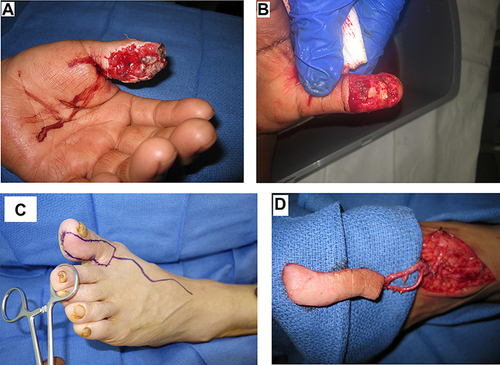 Figure 4 (A) Open wound / soft-tissue defect of the left thumb 3.5×2.5cm with exposure of distal phalanx and flexor tendon. (B) Wound after debridement. (C) The template of the flap and course of the supplying vessels. (D) The flap elevated with vascular pedicle dissected.