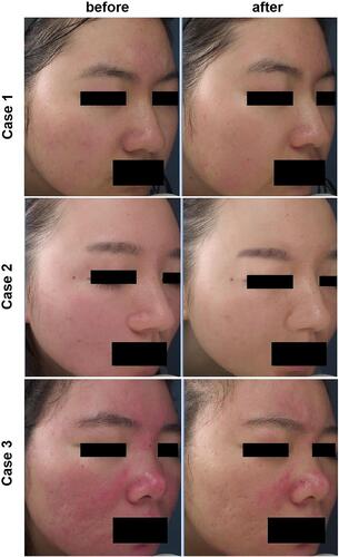 Figure 1 Pictures of three rosacea patients before and after IPL treatment.