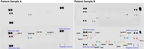 Figure 5 Phospho-tyrosine analysis of human esophageal cancer biopsy samples. Dot blot analysis of two independent biopsy samples demonstrating that specific activated growth factor receptors can be readily identified.