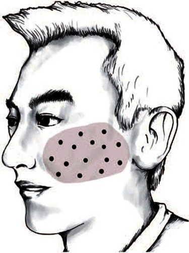 Figure 1 Schematic showing injection sites for BTX-A. The shading shows the distribution of pain and the filled circles represent BTX-A injection sites. Reproduced from Wu CJ, Lian YJ, Zheng YK, et al, Botulinum toxin type a for the treatment of trigeminal neuralgia: results from a randomized, double-blind, placebo-controlled trial, Cephalalgia (32(6)) pp. 443–450. Copyright © [2012] (SAGE Publications).Citation17 