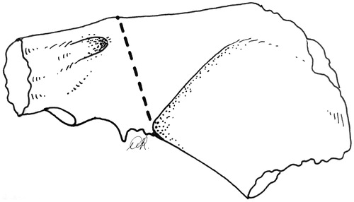 Figure 5. The posterior side of the petrous bone, as seen through the occipital craniotomy, shows the posterior osteotomy from the petrous ridge to the posterior boundary of the jugular fossa.