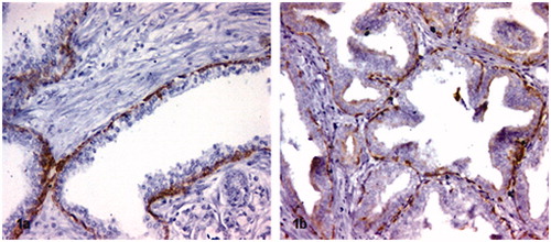 Figure 1. (a) and (b): Immunohistochemical staining of basal cells with SP-A and SP-D proteins (original magnification was 200×).