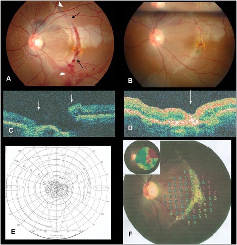 Figure 1 (A) Preoperative fundus photograph: a crescent-shaped retinal rupture near the macula (indicated by the black arrows), a choroidal rupture six disc diameters in size (indicated by the white arrowheads), subretinal hemorrhage, and peripheral retinal edema are seen. (B) Fundus photograph 7 days after surgery: the ruptured retina is closed. (C) Preoperative optical coherence tomography: rupture and subsidence of the retina and choroid and retinal detachment were identified (the arrows indicate the edges of the ruptured retina). (D) Postoperative optical coherence tomography: closure of the ruptured retina is seen, but the choroid and retina show subsidence, and the retinal pigment epithelium (RPE) layer has become thickened (the arrow indicates the scarred RPE near the macula). (E) Goldmann perimetry 4 months after surgery: the central scotoma is decreased, but the nasal crescent-shaped scotoma has become slightly bigger. (F) MP-1 micoperimetry: the ruptured choroid and RPE show scarring; retinal sensitivity is obtained; the ruptured area and superior temporal region of the macula have 0 dB sensitivity, but MP-1 micoperimetry shows the fixation point at the nasal macula; the nasal retina of macular area has normal retinal sensitivity of 16–20 dB; inferior temporal retina shows retinal sensitivity of 6–12 dB.