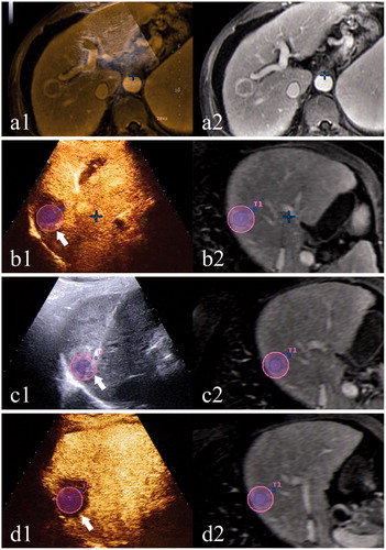 Figure 1. A case using CEUS-MR fusion imaging for intraprocedural treatment response assessment. (a) shows the co-registration process: a1 shows the overlapped US and MR images; the left branch of the portal vein is chosen as an anatomical landmark; a2 shows the corresponding MR image. (b) shows the first CEUS-MR fusion imaging assessment: b1 shows the overlapped CEUS and MR images after the administration of the contrast agent; AM is inadequate (arrow); b2 shows the corresponding MR image with the tumor outlined in blue and the AM in purple. (c) shows the process of supplementary ablation: c1 shows that the electrode is inserted to the site of inadequate AM (arrow) under the guidance of US-MR fusion imaging; c2 shows the corresponding MR image. (d) shows the second CEUS-MR fusion imaging assessment: d1 shows the overlapped CEUS and MR images; adequate AM is obtained (arrow) after the supplementary ablation; d2 shows the corresponding MR image.