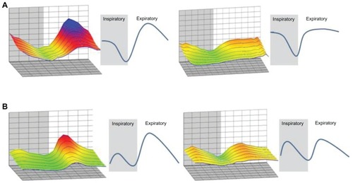 Figure 3 Patterns of change in respiratory resistance during tidal breathing in patients with chronic obstructive pulmonary disease. Respiratory resistance in three-dimensional graphics generated by MostGraph-01 (Chest MI, Inc, Tokyo, Japan) for patients with chronic obstructive pulmonary disease changed dynamically. Based on respiratory resistance at 4 Hz, the changes were classified into two patterns: (A) the sinusoidal pattern, which consisted of one peak and one valley in each respiratory cycle, and (B) the bimodal pattern, which consisted of two peaks and two valleys in each respiratory cycle.