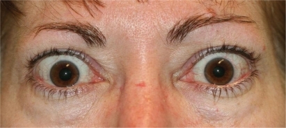 Figure 2 Severe inflammation and proptosis with classic “stare” of thyroid eye disease may be prominent in the active phase of disease.