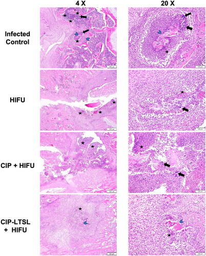 Figure 8. Hematoxylin and eosin (H&E) staining of HIFU treated femurs showed reduced bacterial burden (black arrows), suppurative inflammation (black stars) and osteonecrosis (blue arrowheads) in the HIFU treated groups compared to the untreated infected control, post-second treatment (n = 1). Scale bars: ×4 = 500 μm, ×20 = 100 μm.