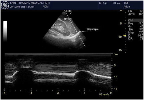 Figure 2. Point-of-care ultrasound of the left hemi-diaphragm in the posterolateral axillary line at the level of the costophrenic angle. A phased array probe is used, and M-mode shows normal excursion of the diaphragm during normal breaths
