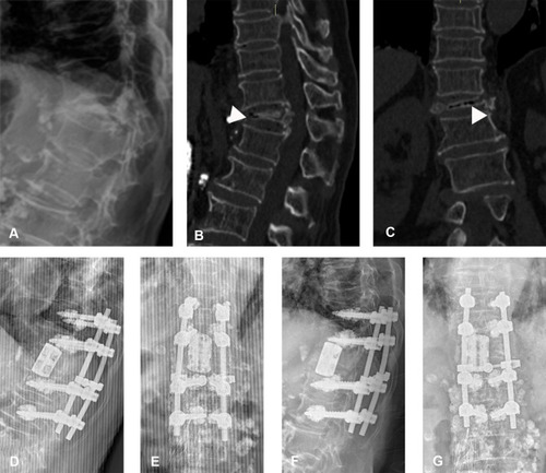 Figure 5 The 3D-printed artificial vertebral body (3DP-AVB) was used in a 75-year-old female patient with stage III Kümmell’s disease. (A) Preoperative X-rays showed T12 collapsed fracture and thoracolumbar kyphosis. (B and C) An intravertebral cleft sign (white triangle) was shown in preoperative CT scans. (D–G) Postoperative and final follow-up plain radiographs showed no cage subsidence and kyphosis recurrence.