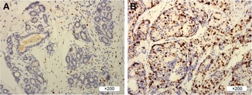 Figure 2 Immunohistochemical staining for Ki-67 expression in breast cancer.