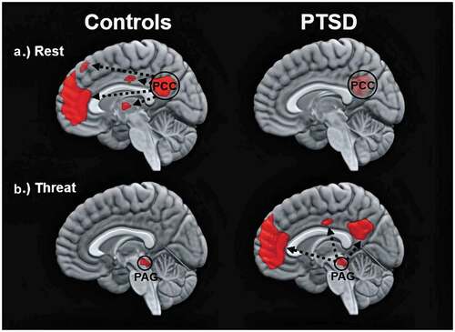 Figure 1. Images show the functional connectivity of the DMN in healthy controls (left) and in participants with PTSD (right) under different conditions. Top and bottom images depict within-group patterns in functional connectivity during rest and during trauma-related stimulus processing, respectively. Whereas resting-state functional connectivity is depicted in relation to the time series of the posterior cingulate cortex (PCC), trauma-related functional connectivity is depicted in relation to the time series of the periaqueductal grey (PAG). Figure 1 is an adaptation from two previous findings, where resting-state and threat-related functional connectivity are related to results by Bluhm et al. (Citation2009) and Terpou et al. (Citation2019a), respectively