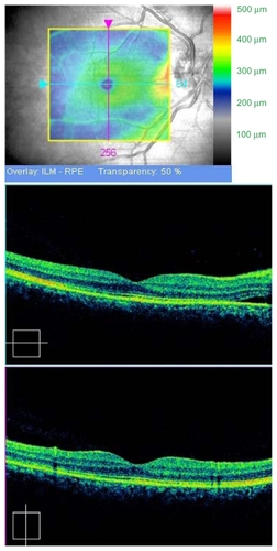 Figure 7 Optical Coherence Tomography Cirrus (Carl Zeiss Meditec, Dublin, CA, USA). The right macular detachment has disappeared.