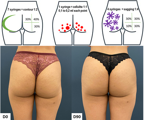 Figure 7 Case 4, Buttocks Beautification 3D. Schematic representation of the injections (above). Standardized posterior images pre and 90 days post injection (below). Each syringe = 1.5 mL of CaHA.