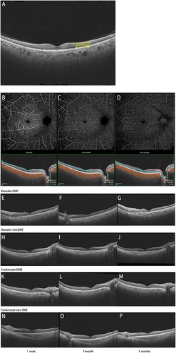 Figure 4 (A) Retinal thickness stratification diagram. (B–D) Retinal vessels perfusion stratification diagram: from left to right, SVP, ICP, DCP. (E–P) Postoperative SS-OCT scans of patients with PDR undergoing vitrectomy plus intraoperative injection of Ozurdex or Conbercept.