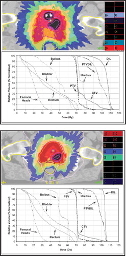 Figure 2. Examples of Tomotherapy planning with dose escalation up to 100 Gy to a double and single DIL: mean DIL dose is 100 Gy (EQD2=122 Gy, α/β=3). The remaining prostate portion receives 71.4 Gy (28 fractions).