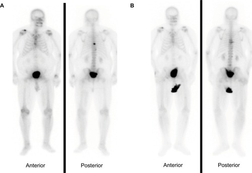 Figure 3 Baseline bone scan (A) and post-therapy scan (B) in a patient with improvement of his few bone metastases but significantly increased pain in the right shoulder such that he requested to discontinue his treatment after the fifth injection of Ra-223 dichloride.Abbreviation: Ra-223, Radium-223 dichloride.