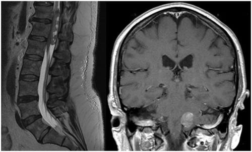 Figure 1. Case 1 sagittal T1-weighted MRI at diagnosis showing a mass from T11-L1 (left – previously reported image [Citation6]). Coronal T1-weighted MRI at recurrence showing a new brain mass in the region of the left foramen of Luschka (right).